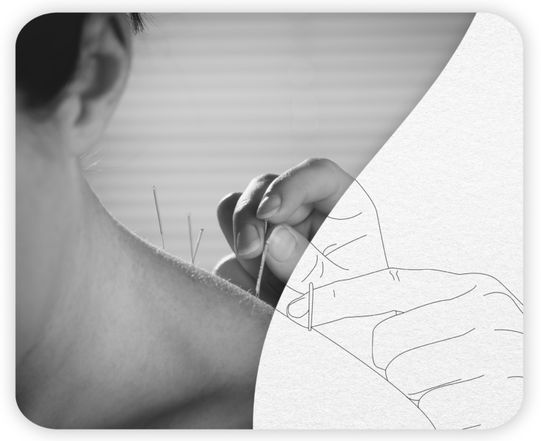 Foto em preto e branco de duas mãos espetando agulhas no ombro de uma pessoa (acupuntura), que se transforma em um desenho de linhas finas da mesma cena.